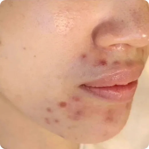 7年以上ニキビに悩んでいた Before