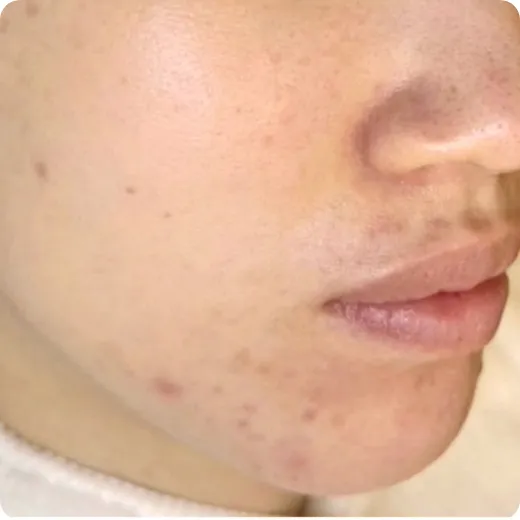 7年以上ニキビに悩んでいた After