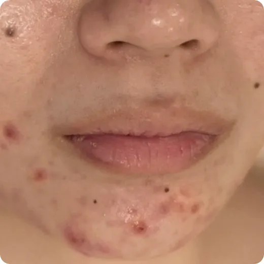 薬を塗っても治らず、治らないと諦めていた Before