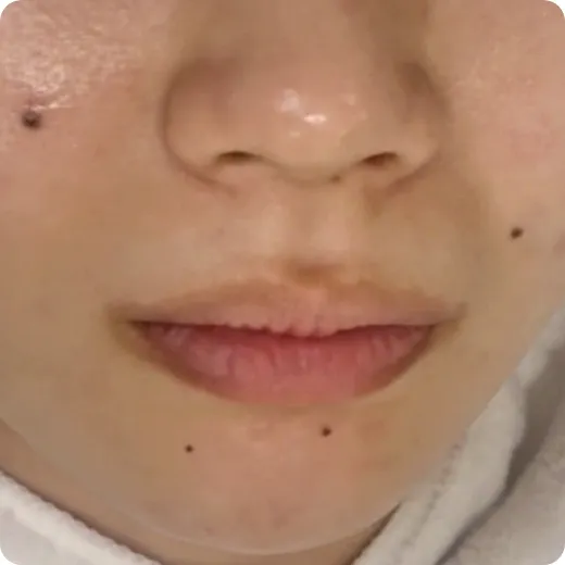 薬を塗っても治らず、治らないと諦めていた After