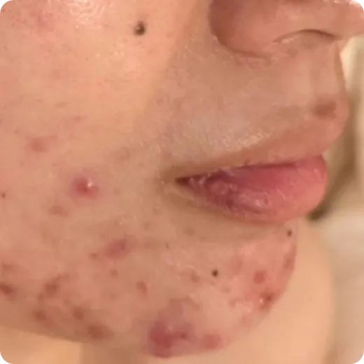 ニキビで顔中が荒れて痛かった Before