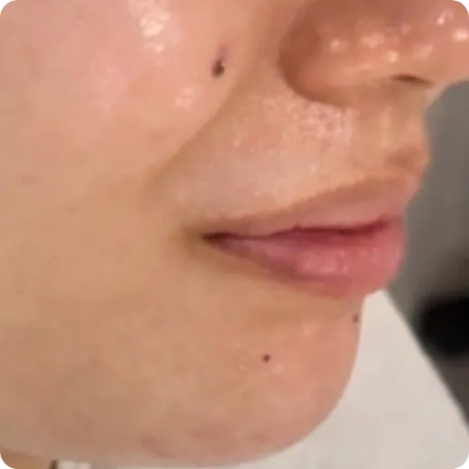 ニキビで顔中が荒れて痛かった After